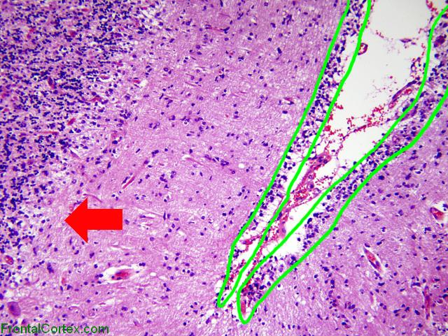 Glioblastoma multiforme involving cerebellum, H&E stain x 100, Labeled