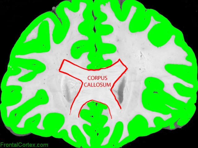 Frontal Coronal, Labeled