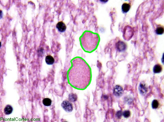 Vanishing White matter disease, H&E stain, high power, Labeled