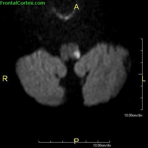 Wallenberg Syndrome MRI