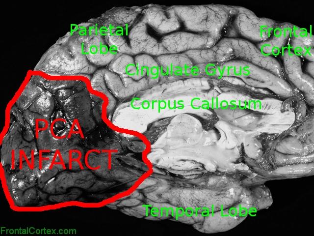 Posterior cerebral artery infarct, mid sagittal section of cerebral hemisphere, Labeled