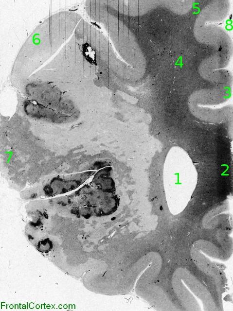 Recent middle cerebral artery infarct, whole mount coronal section through frontal lobe, anatomical landmarks