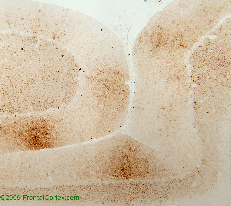 Type 1 prion disease, cerebellum, 3F4 immunohistochemical staining x 100