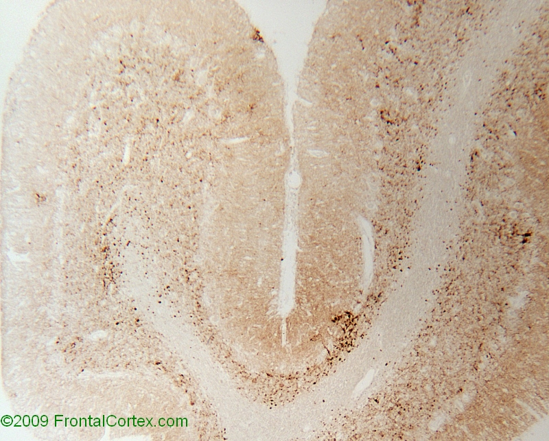 Type 2 prion disease, cerebellum, 3F4 immunohistochemical staining x 100