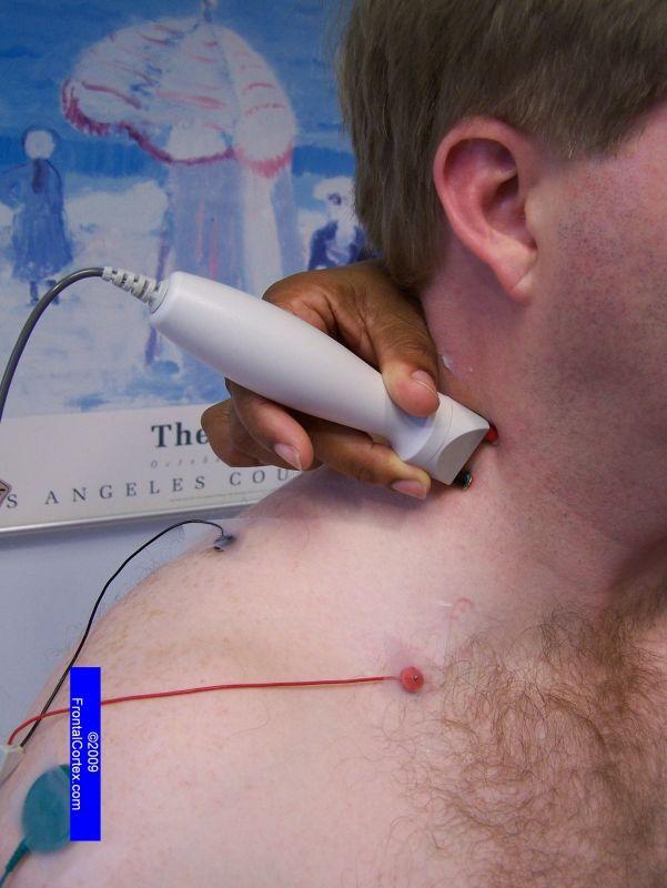 Spinal Accessory Motor Nerve - recording the Trapezius