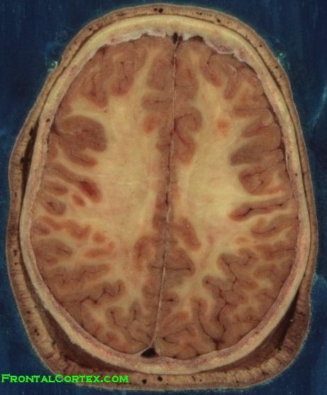 Brain Horizontal VHP