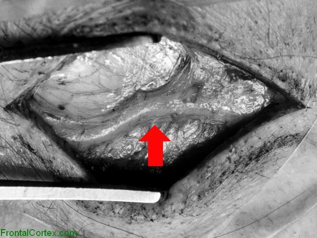 Temporal Artery Surgical Exposure with arrow