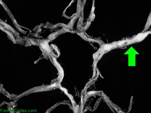 Circle of Willis Dissected - MCA