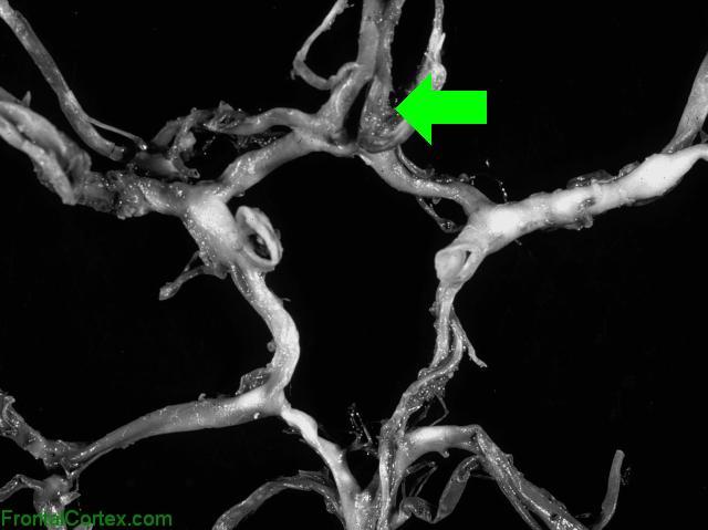 Circle of Willis Dissected - A2