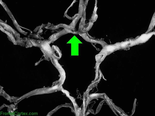 Circle of Willis Dissected - ACOM