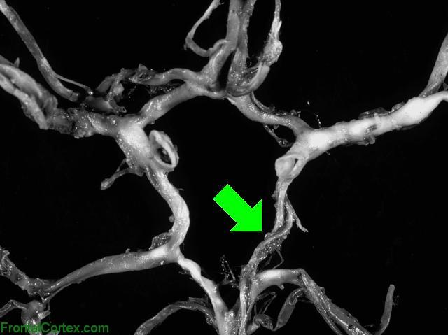 Circle of Willis Dissected - PCOM