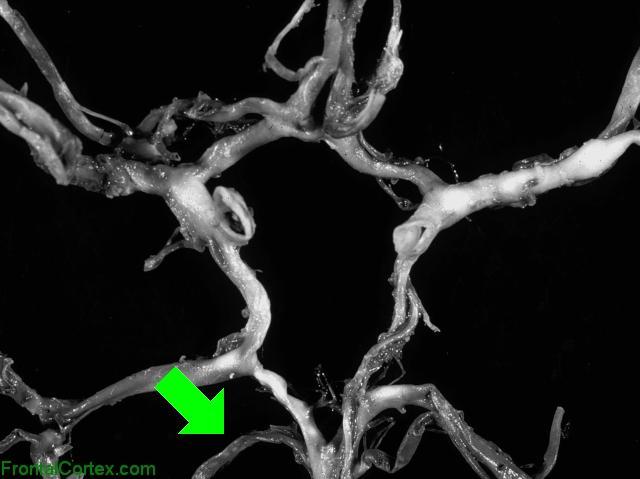 Circle of Willis Dissected - SCA