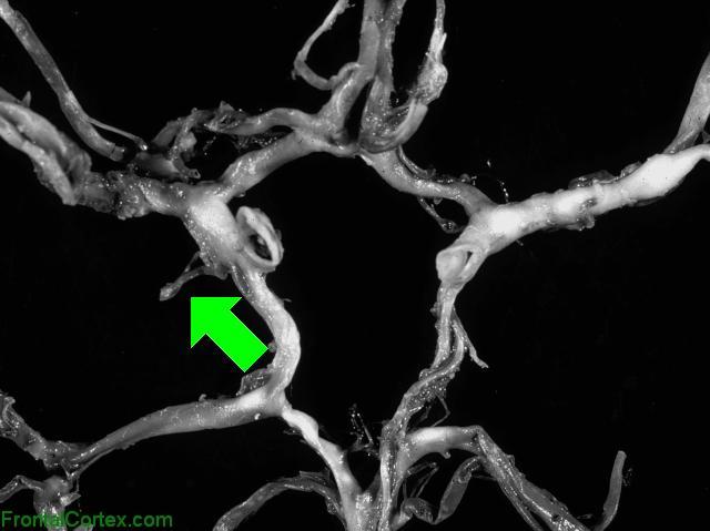 Circle of Willis Dissected - Ant Choroidal