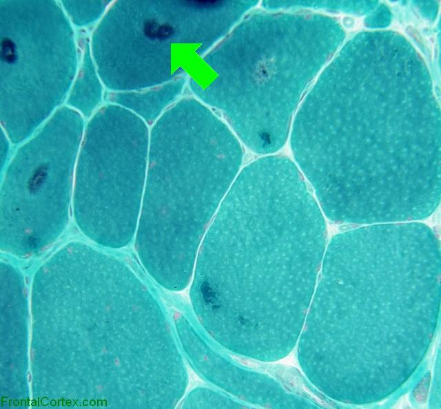 hyaline inclusions trichrome x200 with arrow