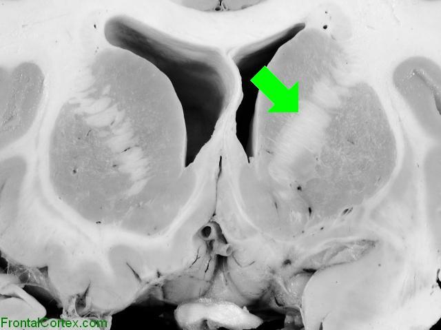 Basal Ganglia Coronal Close - Internal Capsule