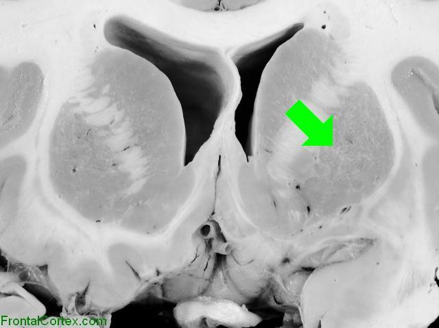 Basal Ganglia Coronal Close - Putamen