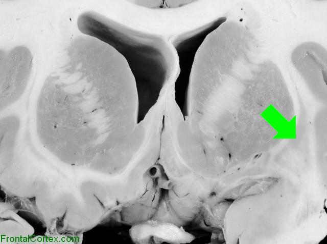 Basal Ganglia Coronal Close - Claustrum