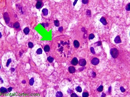 TLDL creutzfeldt cell with arrow