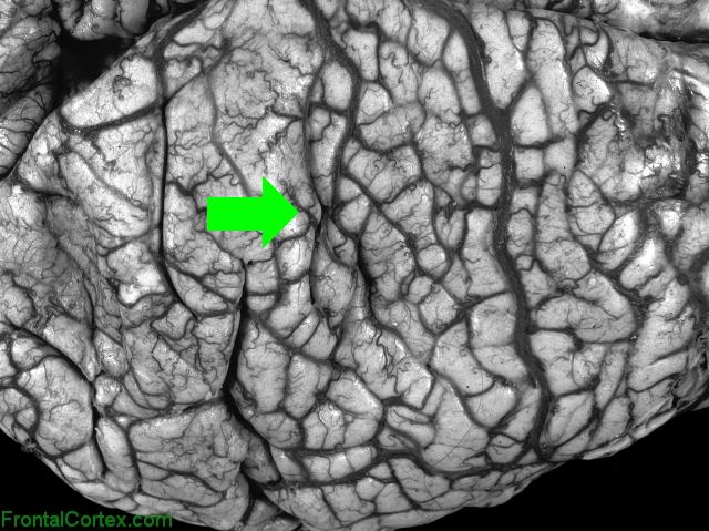 Poly Gyria Dorsal with arrow