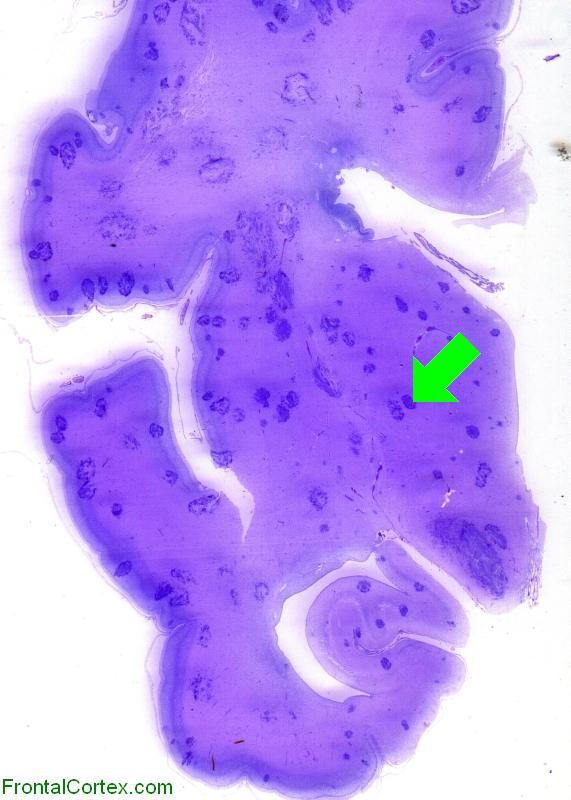 PAS candida WM 001 with arrow