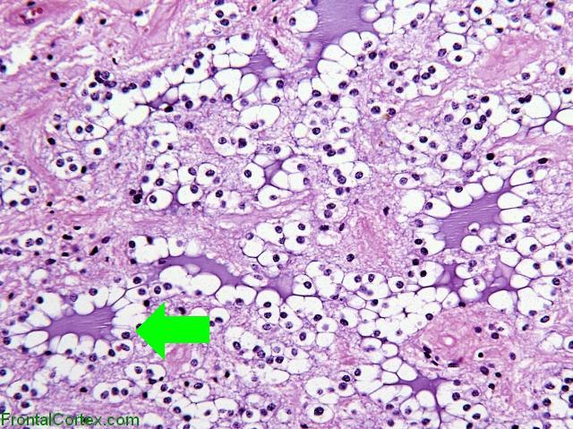 Rosetted Glioneuronal Tumor IVth Ventricle H&E with arrow