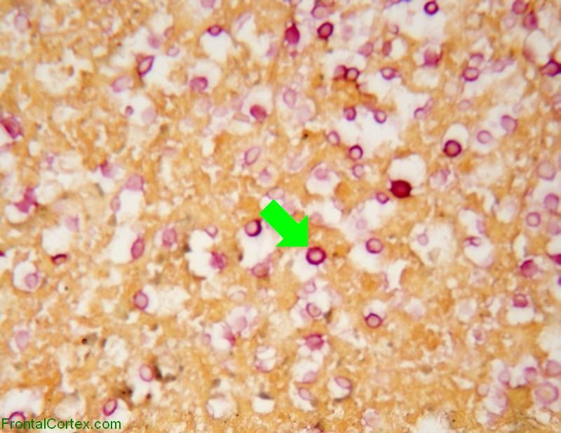 Cryptococcoma, mucicarmine staining, high power with arrow