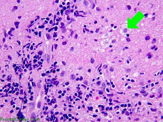 Optic Neuritis, H&E stain x400 with arrow