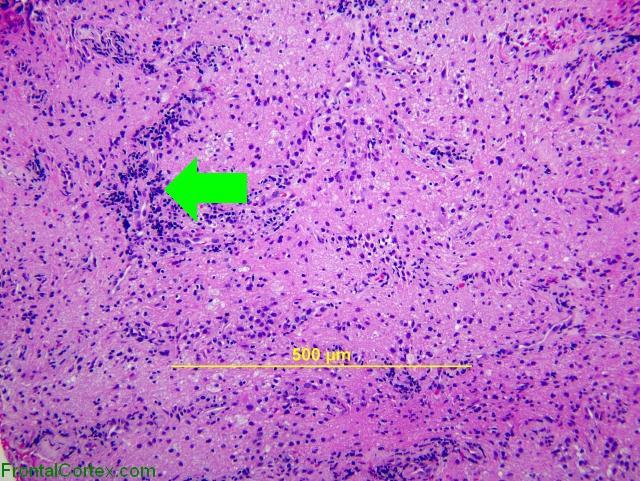 Optic Neuritis, H&E stain x100 with arrow