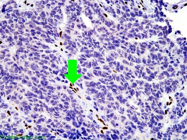 Atypical teratoid/rhabdoid tumor, BAF-47 immunohistochemical staining with arrow