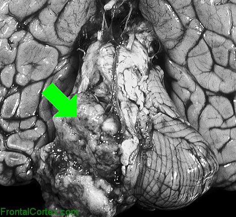 Atypical Teratoid Rhabdoid Tumor Ventral with arrow