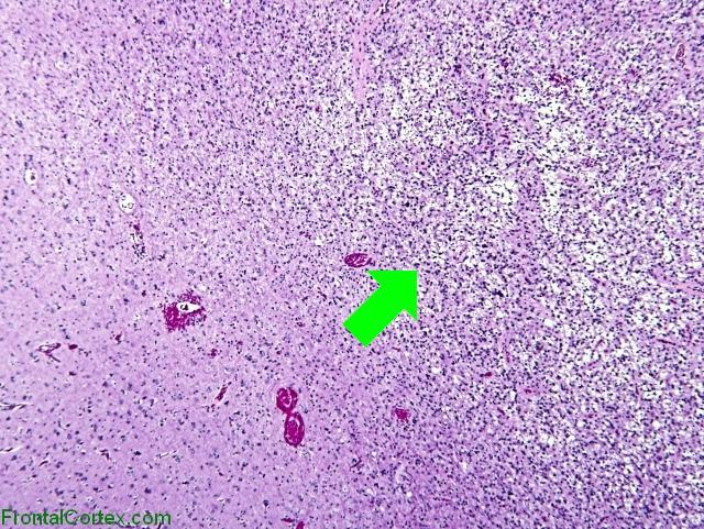 Lobar pilocytic astrocytoma, H&E stain x40 with arrow