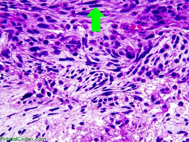 Gliosarcoma , H&E stain x400 with arrow