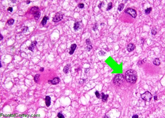 Tumefactive demyelination, H&E stain x 400 with arrow