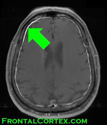 MRI - Enhancing Meninges with arrow