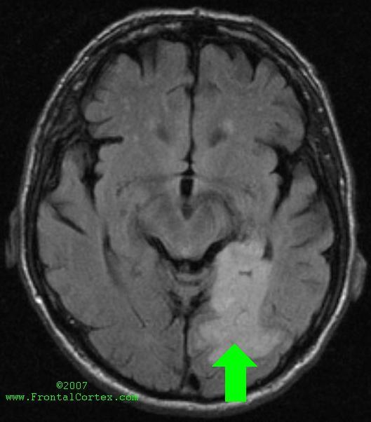 Alexia without agraphia resulting from ischemic stroke with arrow