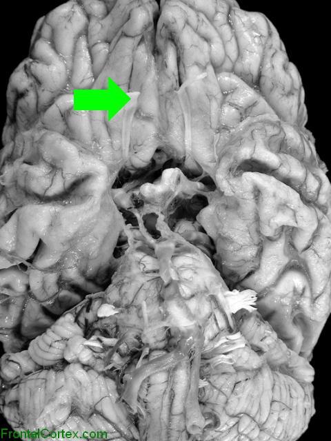 Olfactory nerves and olfactory bulbs with arrow