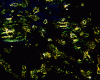 Amyloidoma, cerebral cortex, polarization microscopy after Congo red stain.