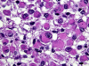 Rhabdoid Meningioma, high power H&E stained slide