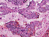 Primary meningeal melanoma, H&E stained slide x 200.