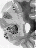 Recent middle cerebral artery infarct, whole mount coronal section through frontal lobe.