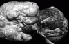 Occipital encephalocele, ventral surface of brain