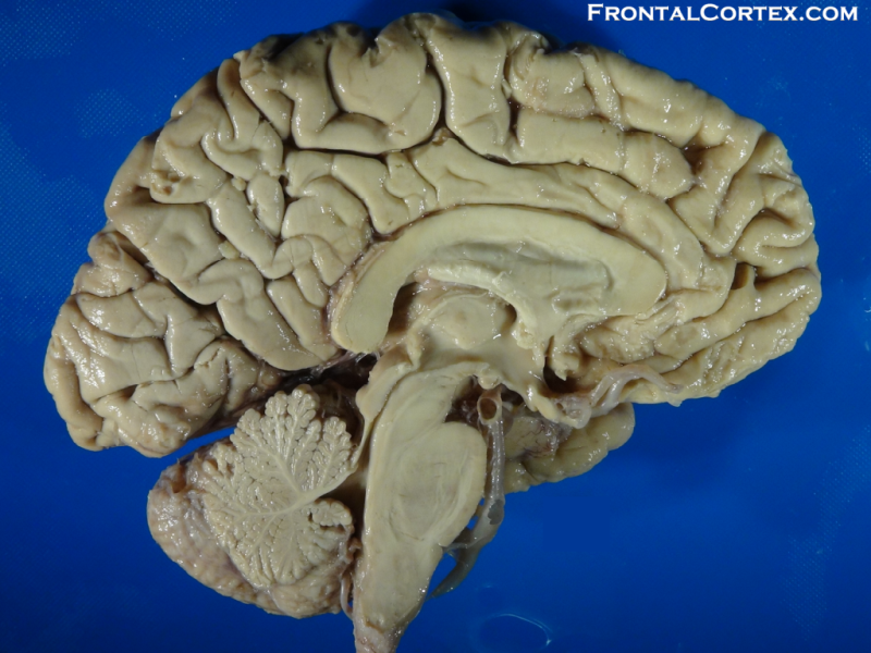 Medial View Normal Gross Brain