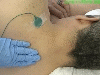 Middle Cervical Paraspinal Muscles EMG Technique
