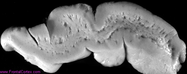 Neuropathology Images | Miscellaneous Cerebrovascular | Etat crible