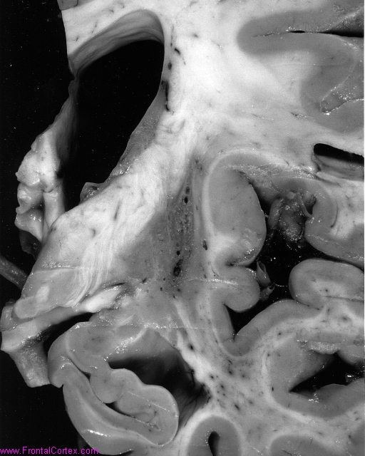 MSAhemiputamen094_5