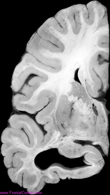 coronal