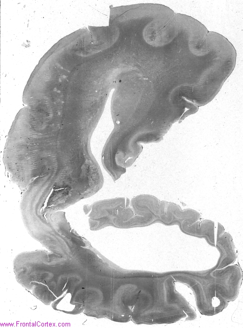 HemimegKluverWM