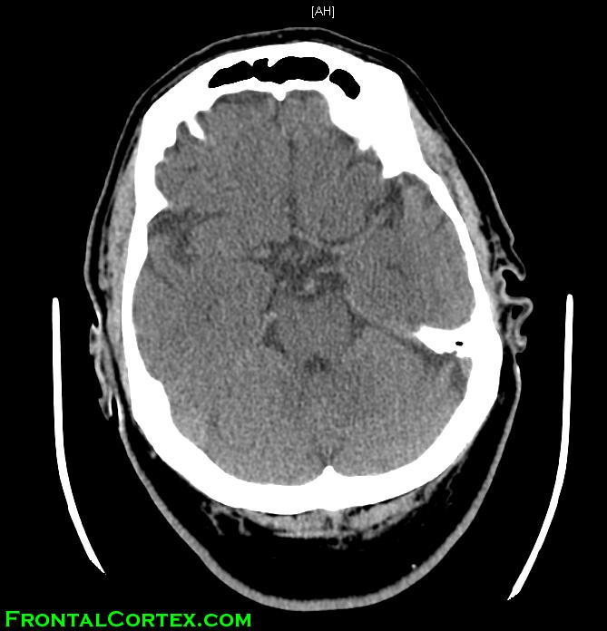 Image: Normal head CT