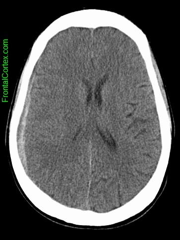 Image: CT SDH 2