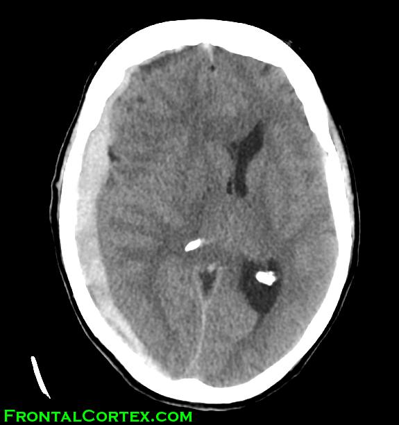 Image: CT SDH mass effect and midline s